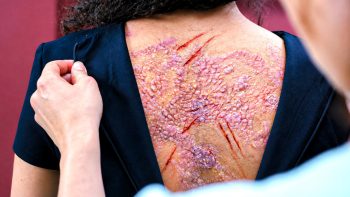 marion-le-corroller-sanguine-maquillage-entretien-2026 Une main écarte le col noir du vêtement d'une femme aux cheveux bouclés, dévoilant le haut de son dos ; sa peau est couverte de plaques épaisses et boursouflées, aux teintes roses, violacées et jaunâtres ; une multitude de petites excroissances forme une surface irrégulière, traversée de plusieurs entailles rouge sang ; au premier plan, une personne vêtue de bleu pâle examine les lésions ; plan du film SANGUINE de Marion Le Corroller.